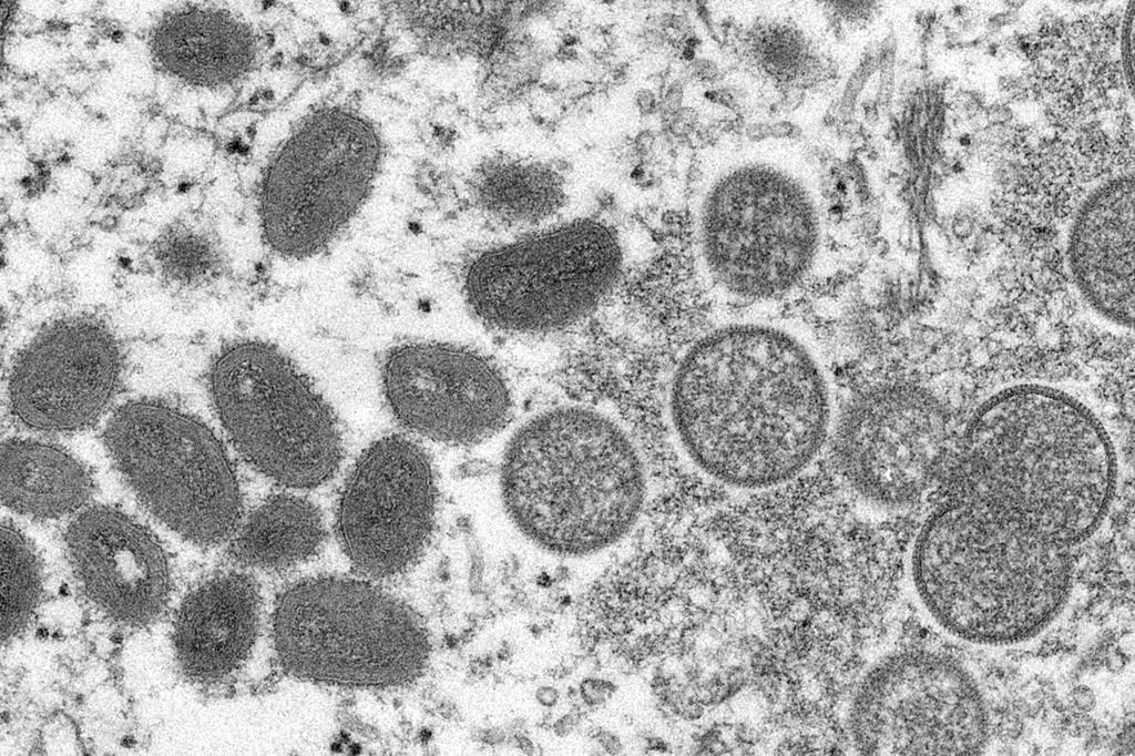 OMS: près de 200 cas de variole simienne dans une vingtaine de pays